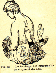 Fig. 185. : Le hachage des muscles de la nuque et du dos.